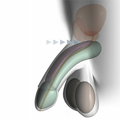 Grafische Darstellung eines Penis und der operativen Durchtrennung des Haltebandes im Körper zur Penisverlängerung.